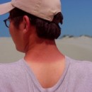 How to Heal Sunburns